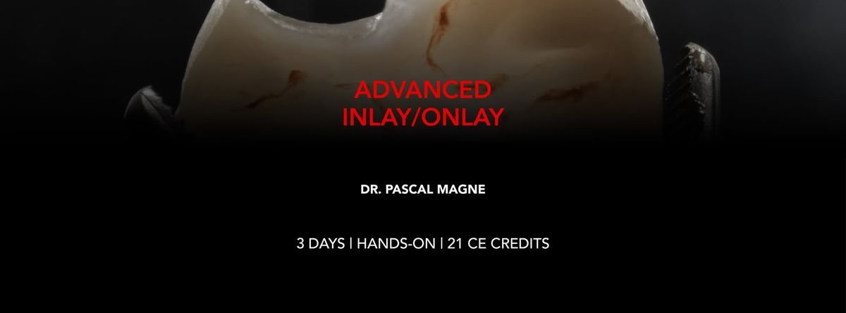 ADVANCED INLAY\/ONLAY