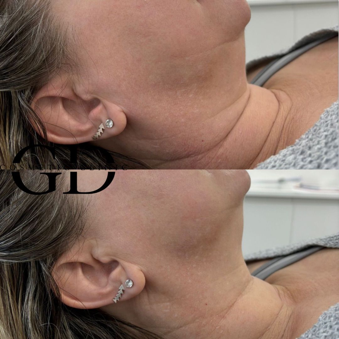 Incredible Non-Surgical Facelift Results!