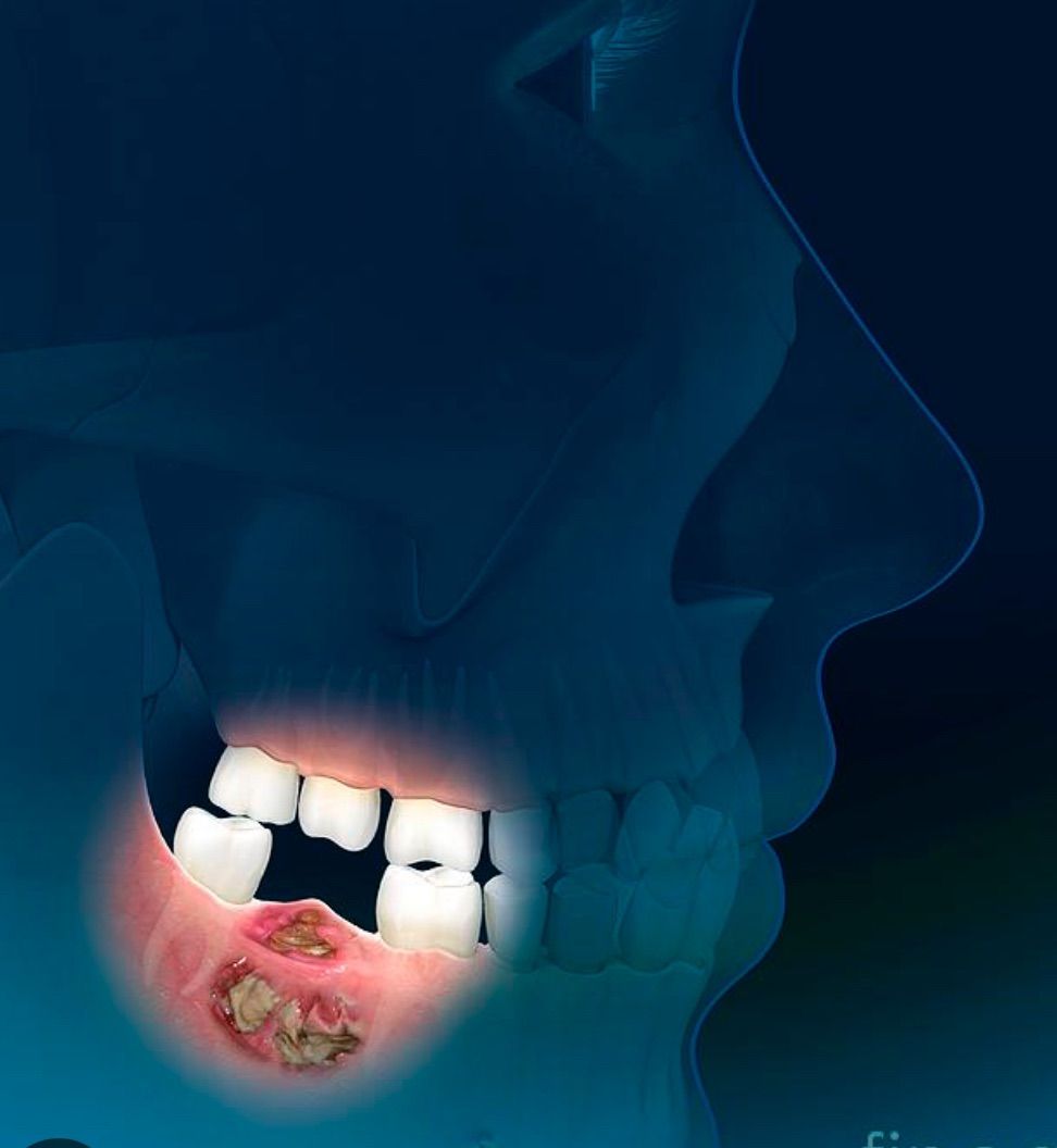 Simpozion Osteonecroza de mandibula- de la mit la adevar stiintific