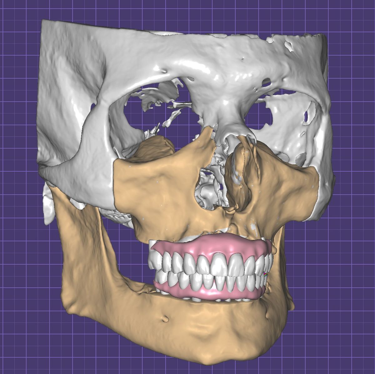 Patient Avatar Driven Workflows for All-On-X Treatments