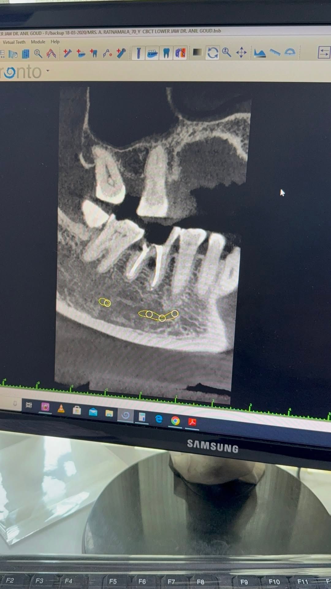 Master the Art of Immediate Implant Placement in Molar Extraction Sockets!