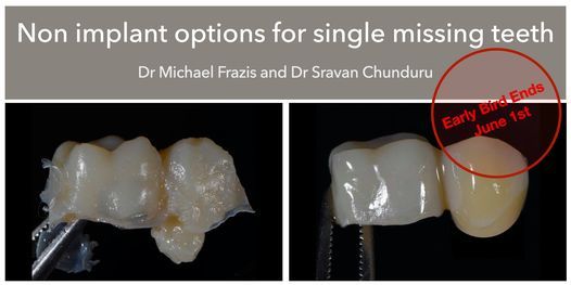Non-Implant replacement options for single missing teeth 2021