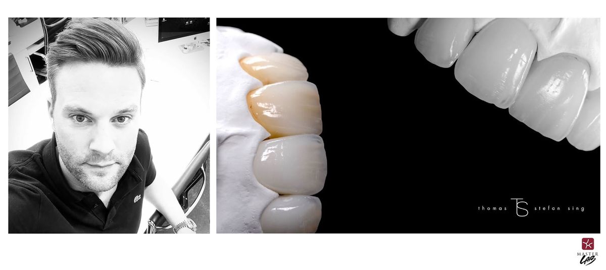 MDT Thomas Stefan Sing | 4 Upper Anterior Zirconia crown 