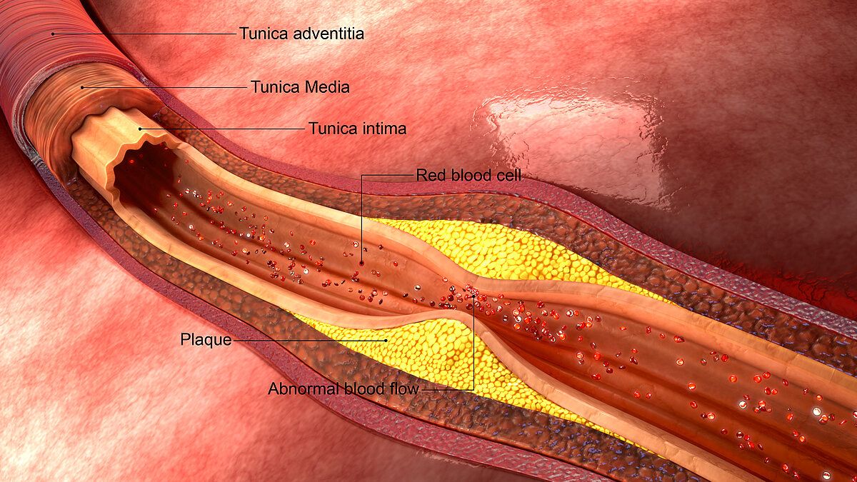 Carotid Artery IMT Ultrasounds - Assess Your Plaque