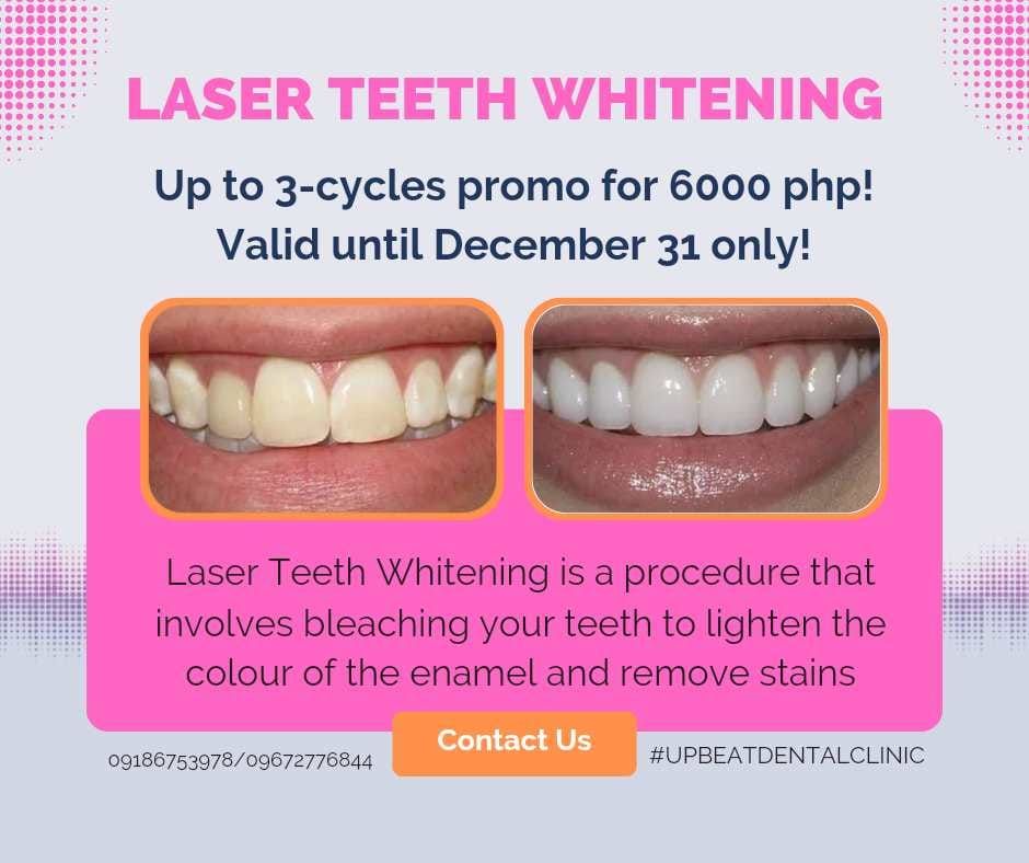 Laser Teeth Whitening Promo