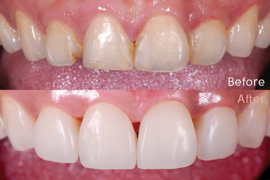 Simplifying Aesthetic Anterior Composite Resins