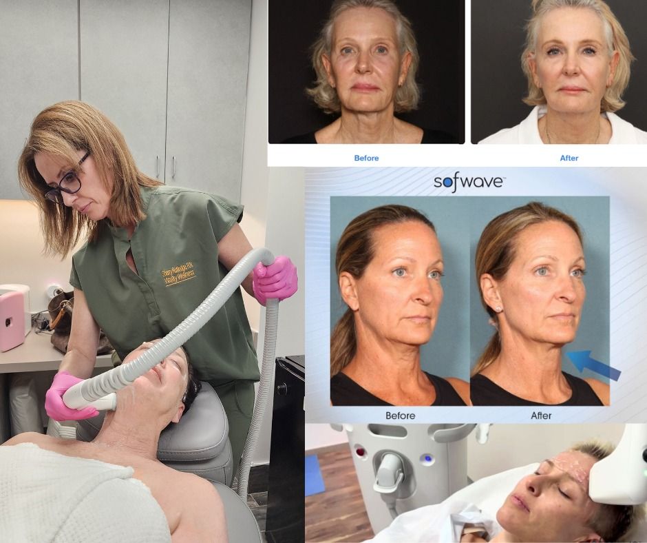 SOFWAVE- Skin Lifting & Tightening Treatment at Vitality Wellness Med Spa