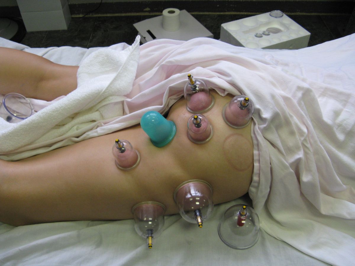 Professional Cupping Therapies Red Deer 