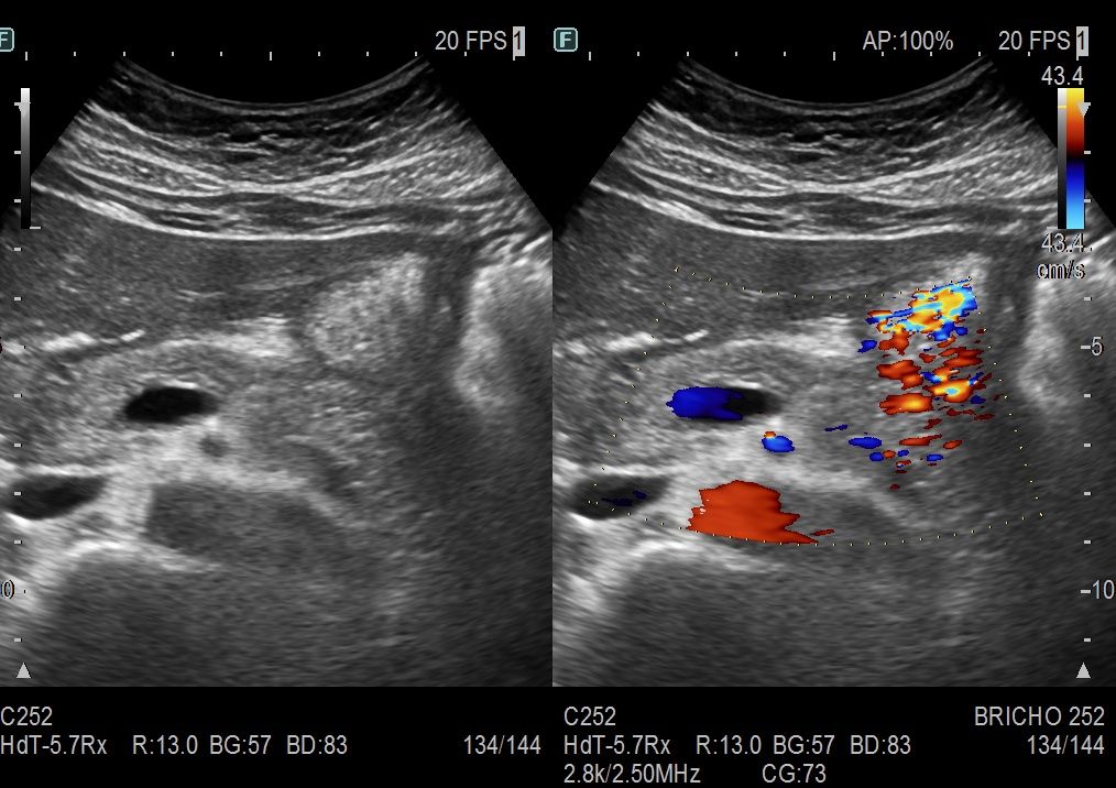 Abdomin\u00e1ln\u00ed sonografie - z\u00e1kladn\u00ed kurz