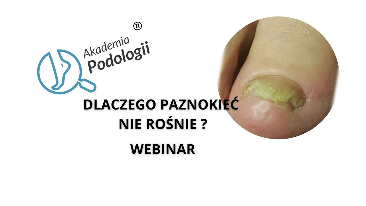 Dlaczego paznokie\u0107 nie ro\u015bnie ? Kompleksowe spotkanie edukacyjne on-line dotycz\u0105ce zaburze\u0144 wzrostu