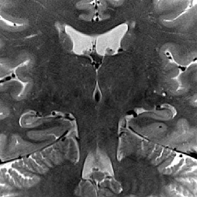 Hippocampal Subfields Group