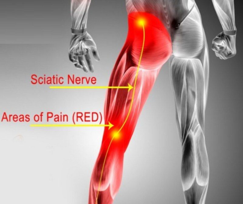 Run Pain-free: Sciatic Nerve Pain causes and prevention for runners