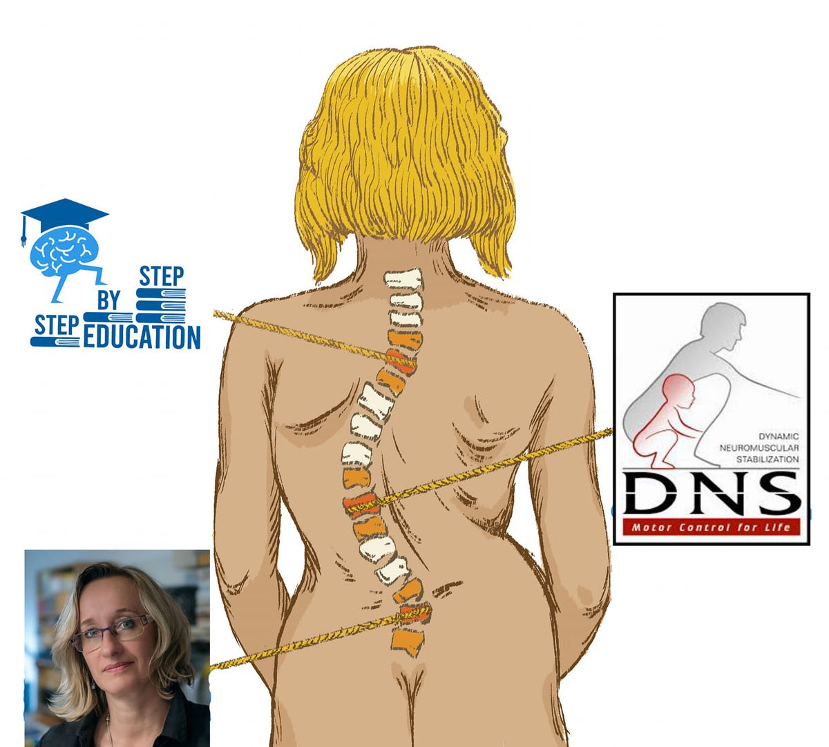 Dynamic Neuromuscular Stabilization on Scoliosis