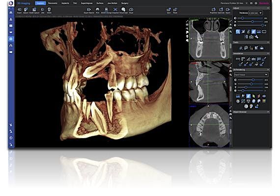 What Dentists Can Easily Miss & What they Need to Look for in CBCT Images