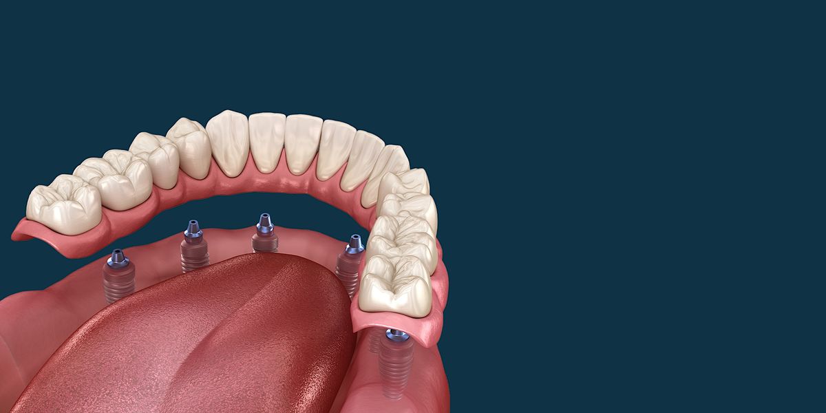 Full Arch Implant Reconstruction: Breaking Down Complex Treatment Plans