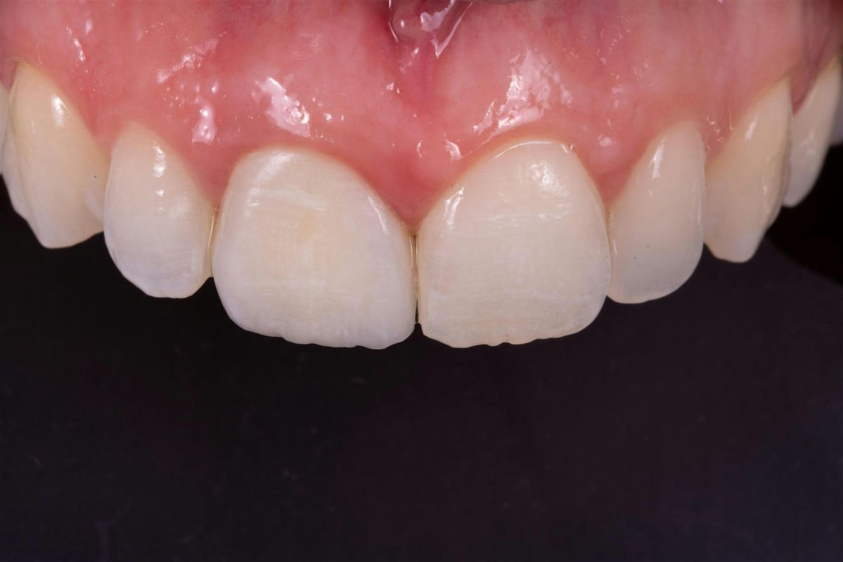 Northern Beaches Multidisciplinary Lecture: The restoration\/replacement of the maxillary incisor