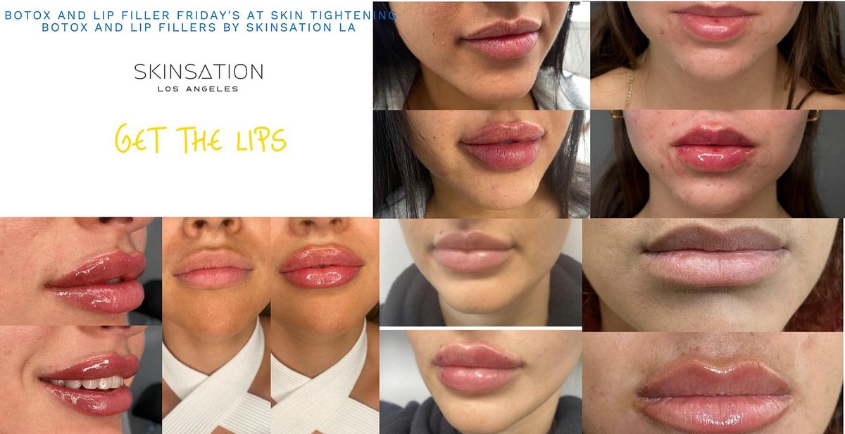 Lip Filler and Botox Fridays at our Medical spa in Los Angeles