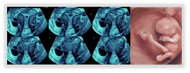 Advances in Imaging and First Trimester Ultrasound Series -- Day Three