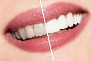 Charlotte NC Teeth Whitening\/Tooth Gem Course