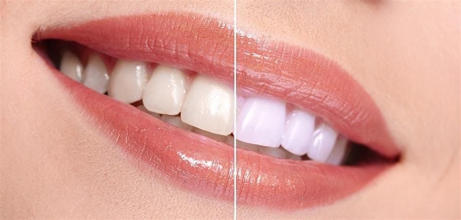 Orlando FL Teeth Whitening\/Tooth Gem Course