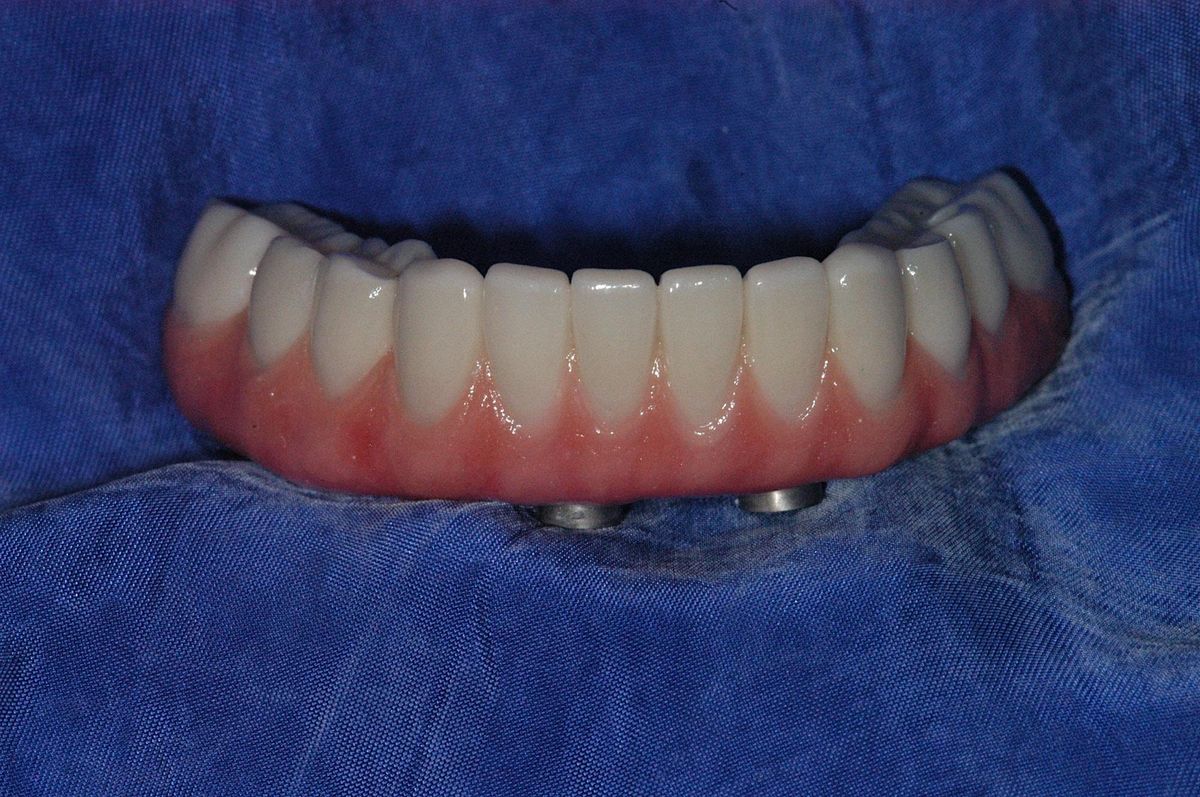 New Course:  Immediate Full Arch Implant Reconstruction