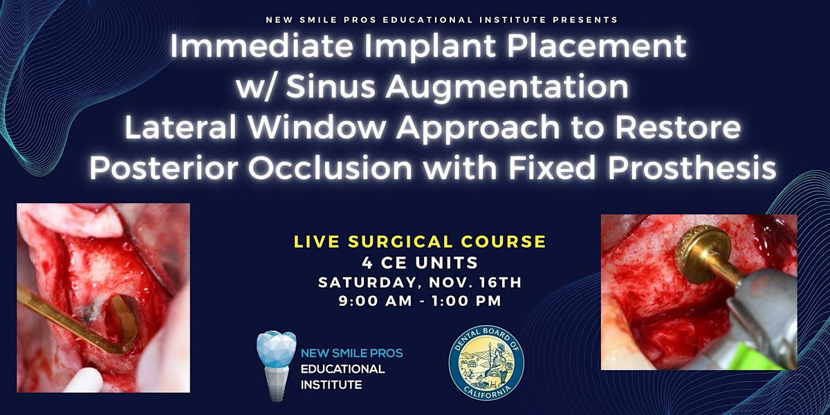 Immediate Implant w\/ Sinus Aug. Lateral Approach for Posterior Prosthesis