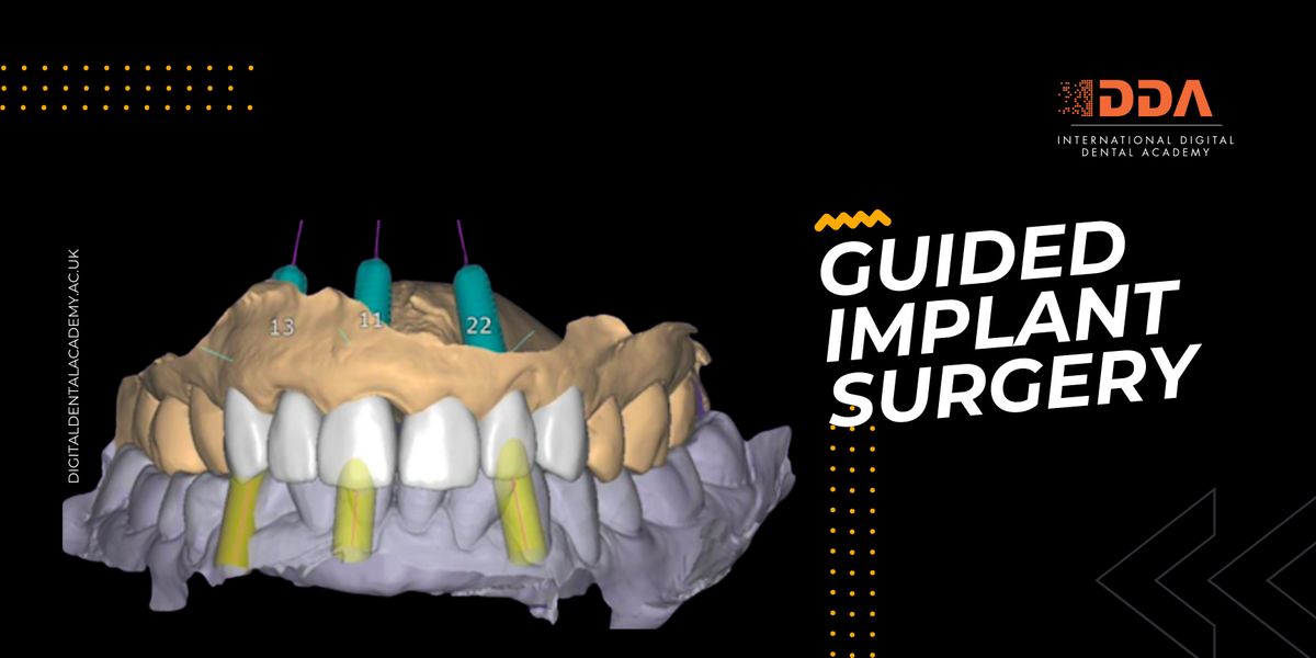 Getting Started with Guided Implant Surgery with ExoPLAN