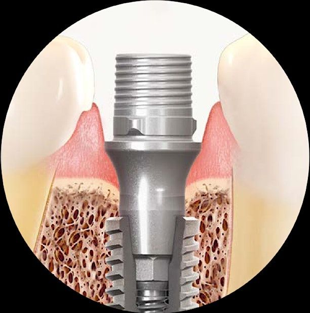 Restoring a Morse Taper Implant System for Singles @ Andover Sample Lab