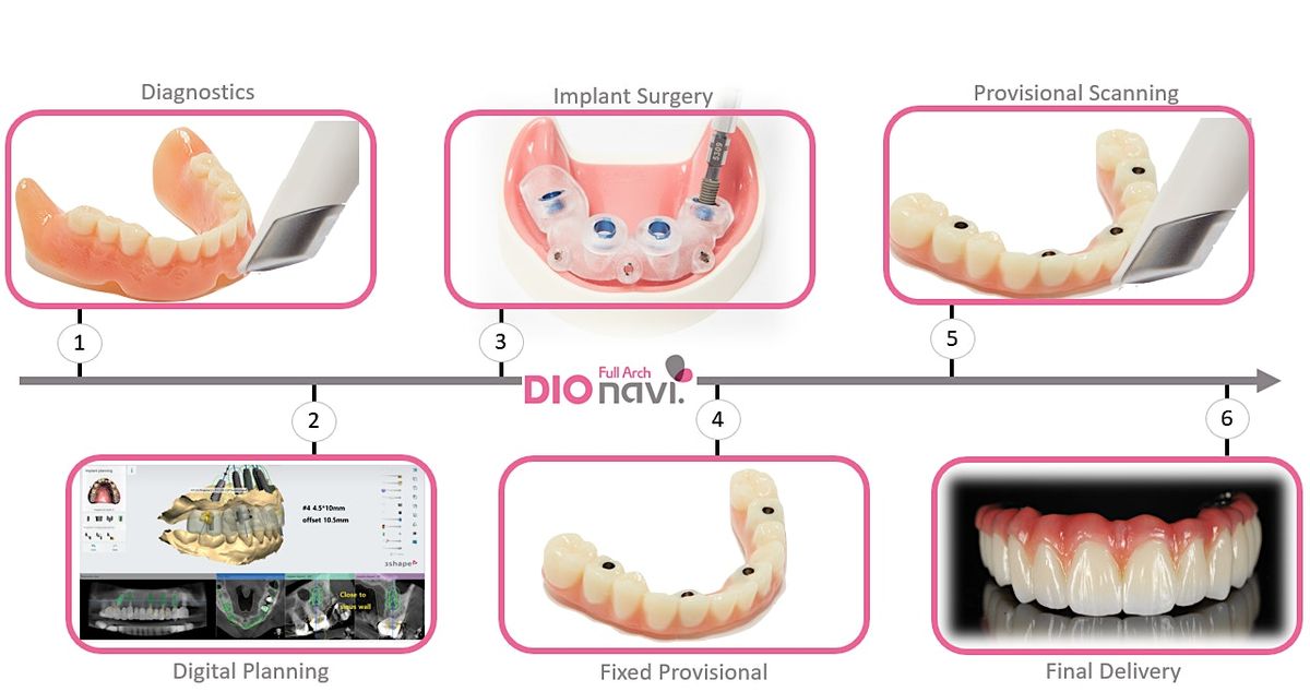 Guided Implant Placement for Full Arch Restoration I Fairfax, VA