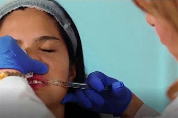 Advanced Lip Filler Injection Techniques - Cincinnati, OH