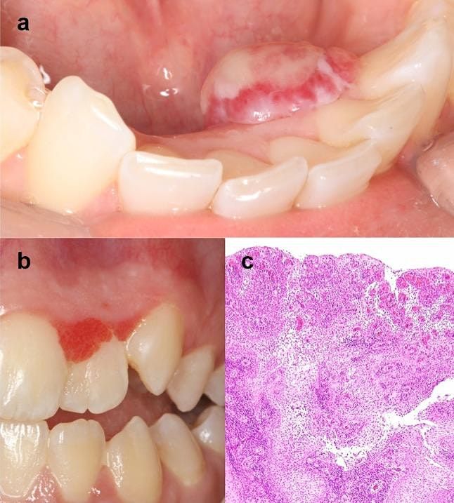 Red, White and Ulcerative Lesions: When bad things happen to  oral mucosa