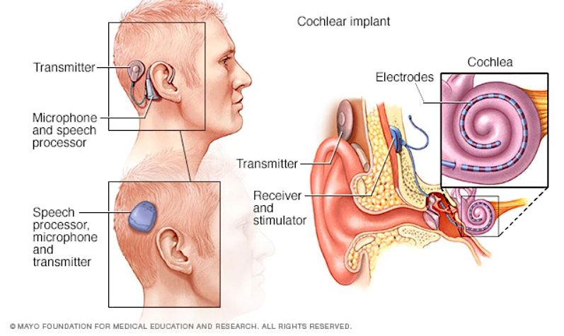 Treatment Options for Hearing Loss: The ENT's Perspective