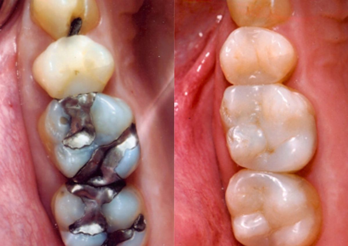 Simplifying Adhesive Dentistry