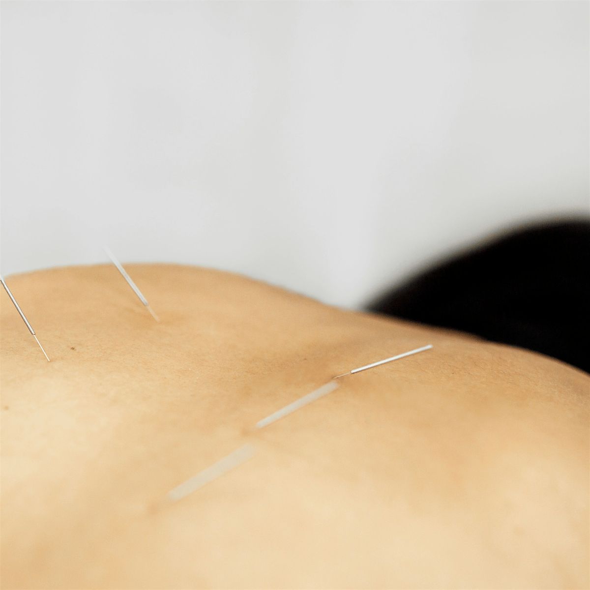 FREE Initial Treatments from Acupuncture Students!