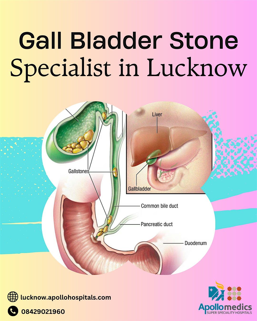 Gall Bladder Stone Specialist in Lucknow