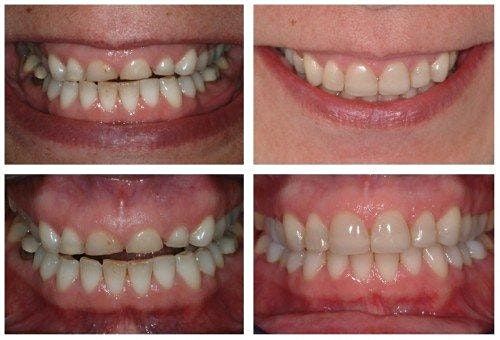 The Worn Dentition:  Finding ways to Meet & Treat the Challenges