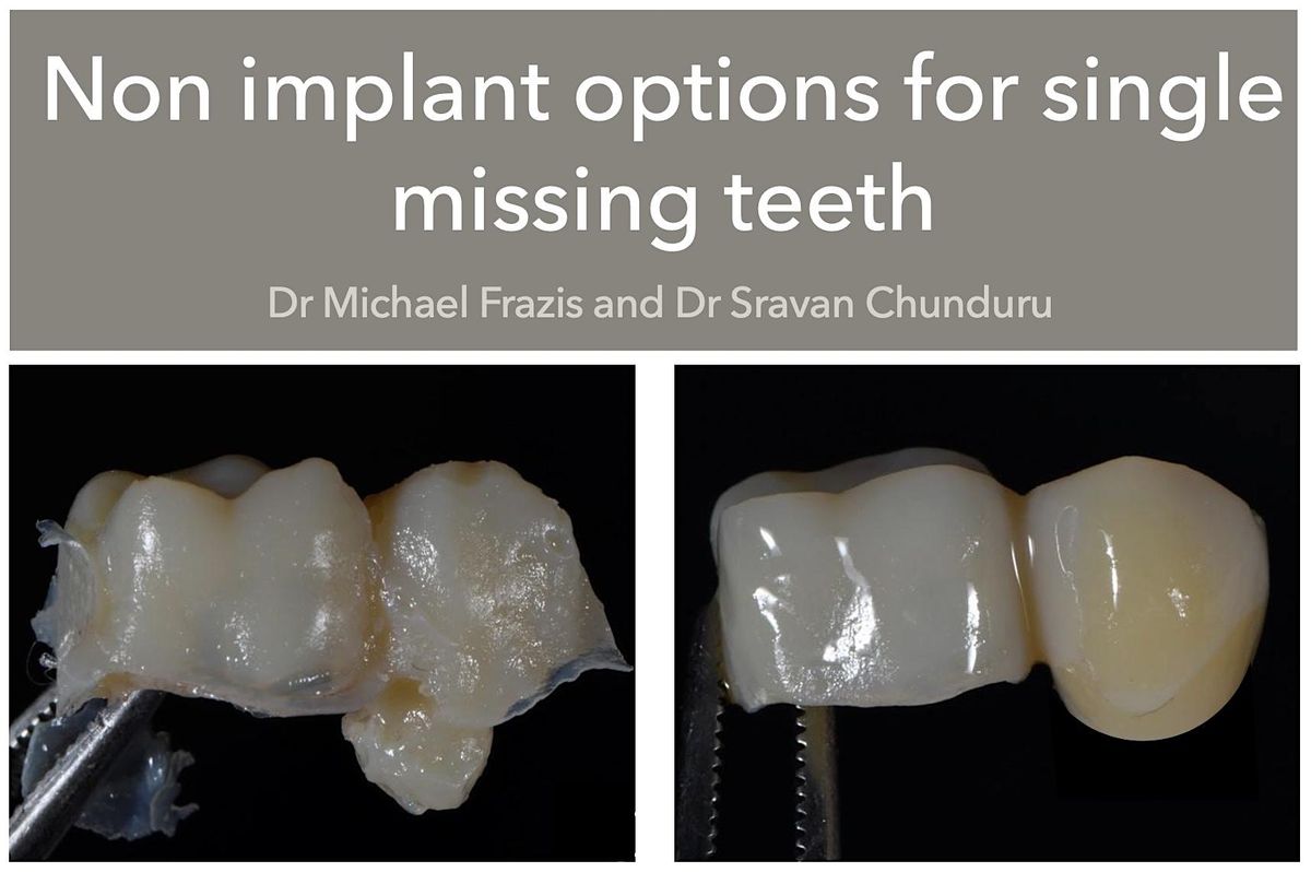Non-Implant replacement options for single missing teeth 2023