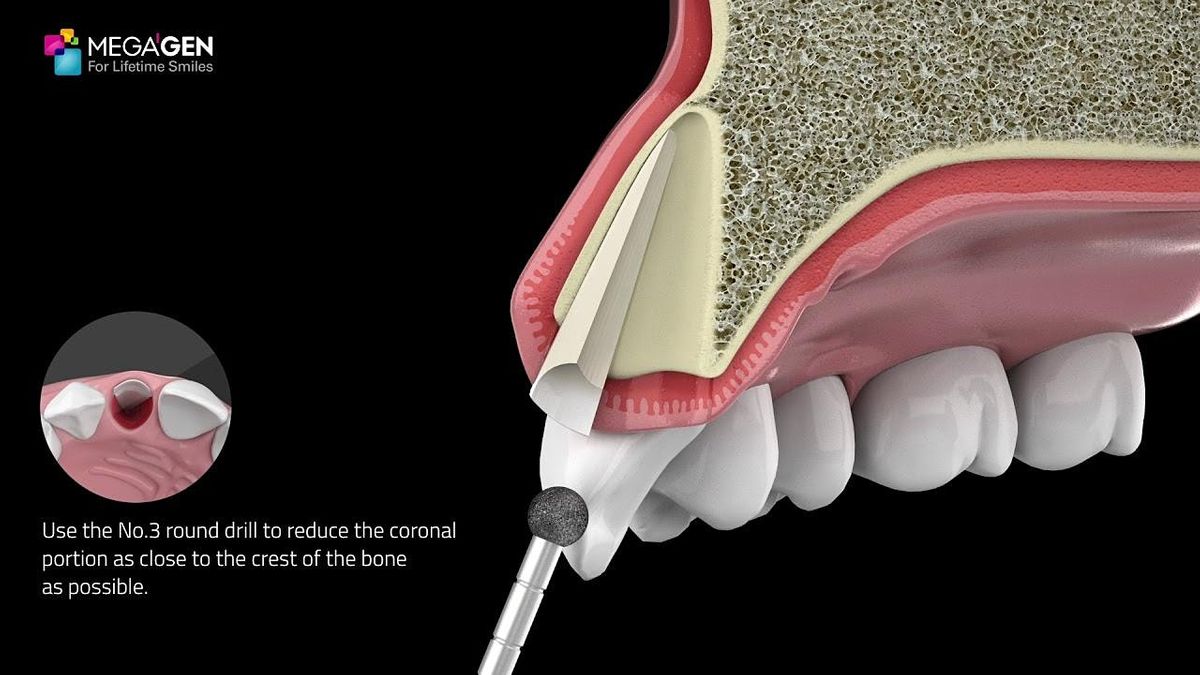 Root Pet Partial Root Extraction Therapy (PET), Your Office of Home Computer ...