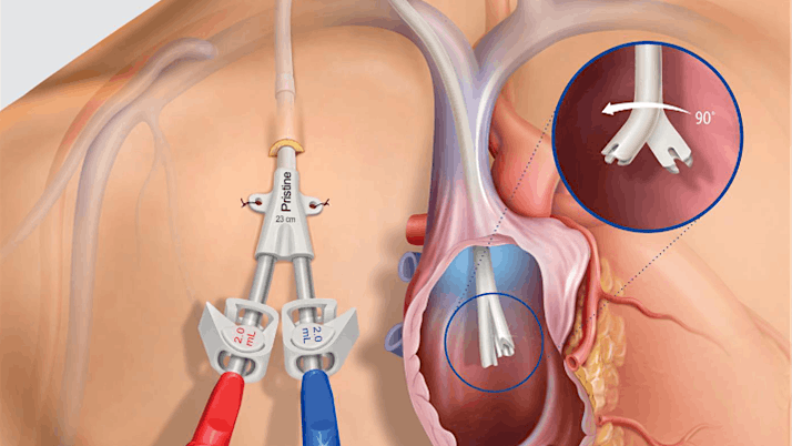 BD\/Bard Vascular Dialysis Catheter Dinner