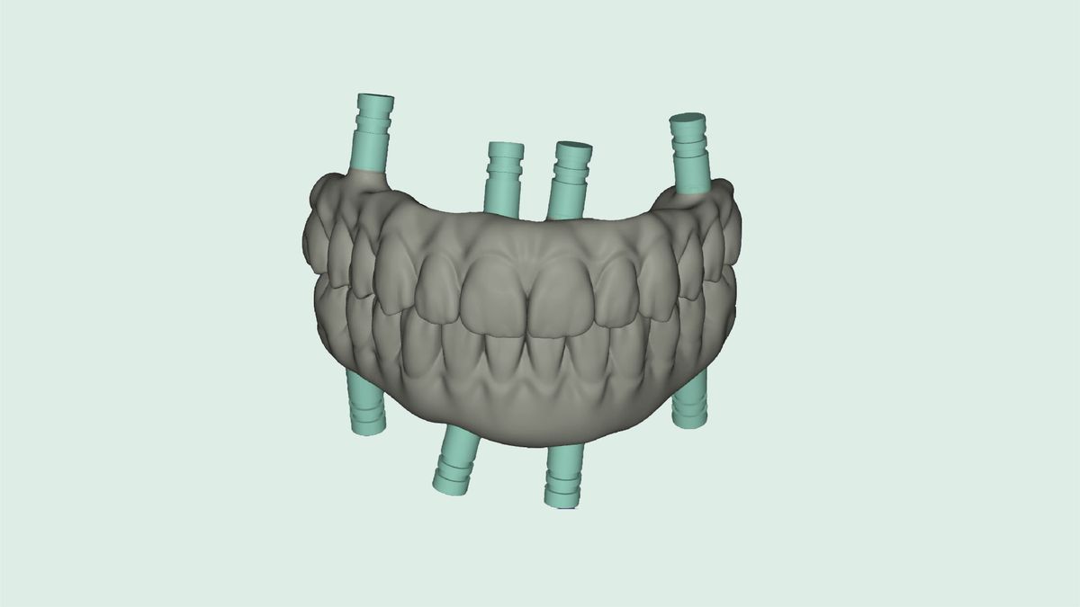 IPG: Redefining All-on-X Implant Capture with Intraoral Photogrammetry