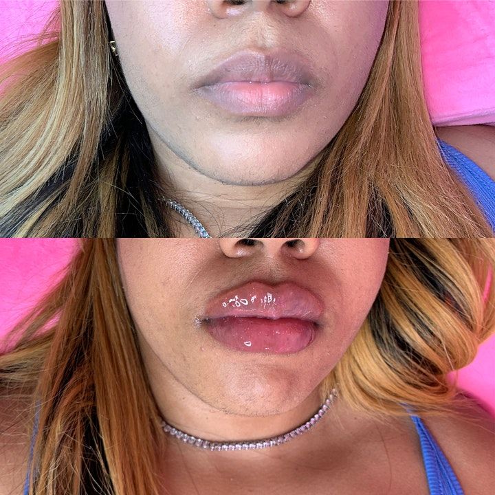 HYALURON PEN LIP TRAINING NO NEEDLE LIP FILLER HANDS ON, LOS