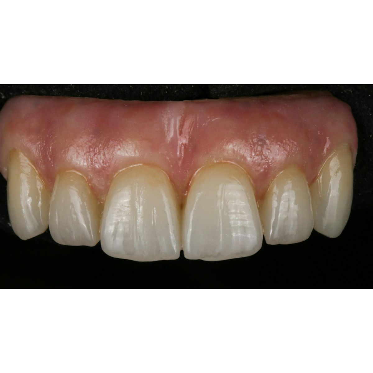 MiYo and Monolithic Zirconia Hybrids