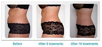 Non- Surgical Body Contouring  Training & Certification Class