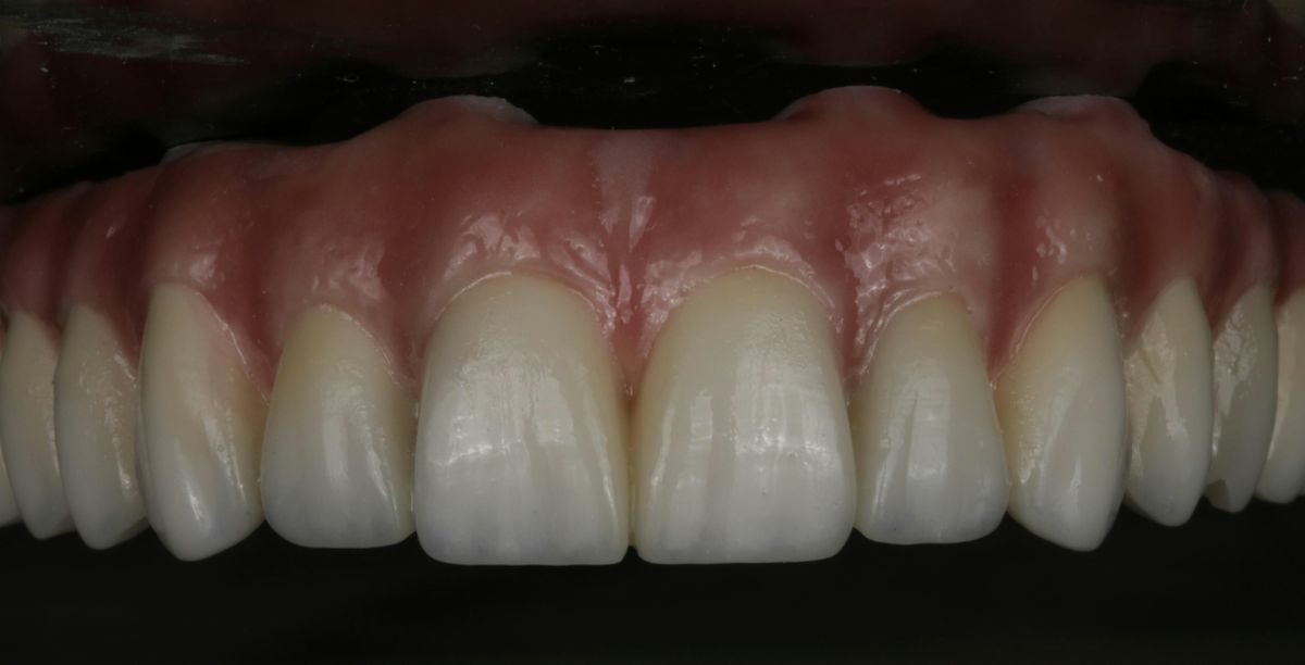 MiYO and Monolithic zirconia hybrids