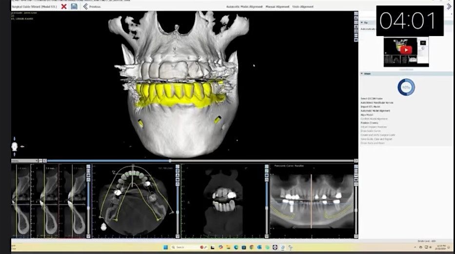 DESIGNING SURGICAL GUIDE IN UNDER 5 MINUTES