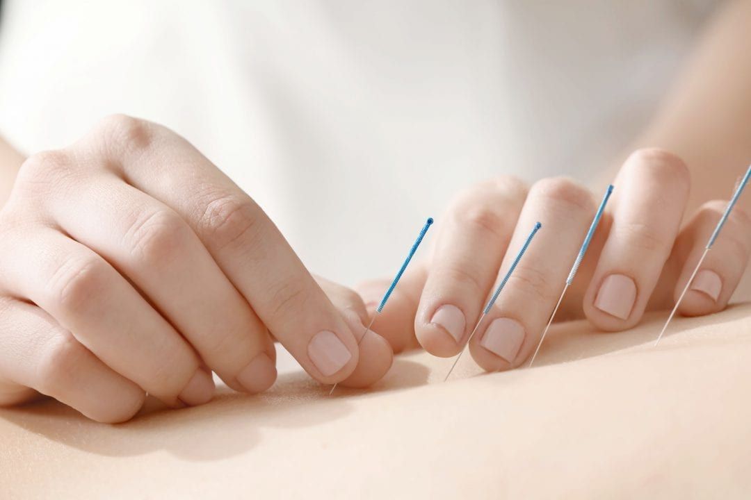 Dry Needling & Medical Acupuncture for Women's Health