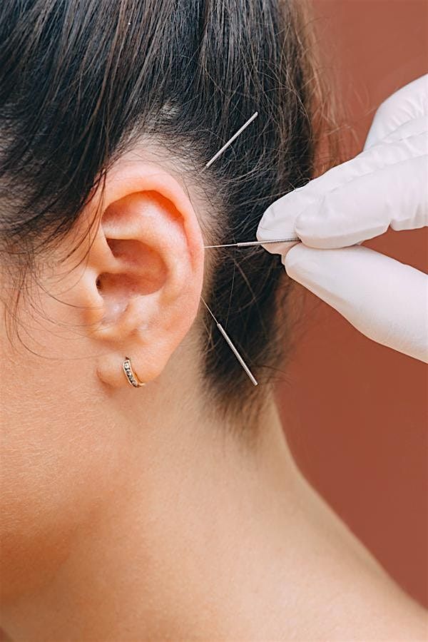 Community Ear Acupuncture for Stress & Anxiety \u2728