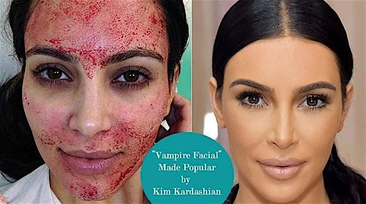 VAMPIRE PRP FACIAL!\u200d\u2728