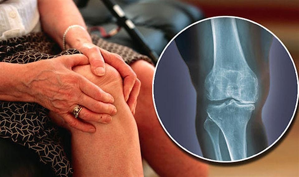 Free Health Talk- Osteoarthritis