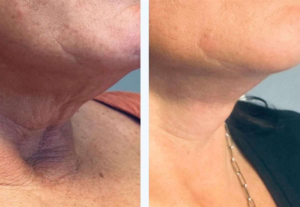 PLATELET RICH FIBRIN AND RADIESSE NECK TREATMENT DEMONSTRATION
